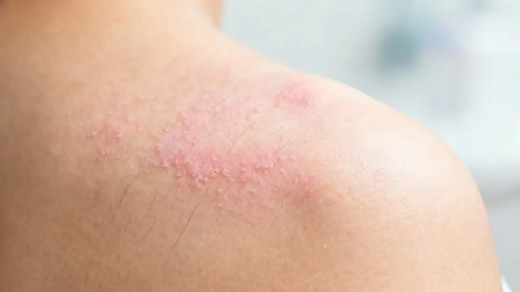 Un nouvel espoir pour le psoriasis : L’Icotrokinra, un traitement oral ciblé, transforme la vie des adultes et des adolescents